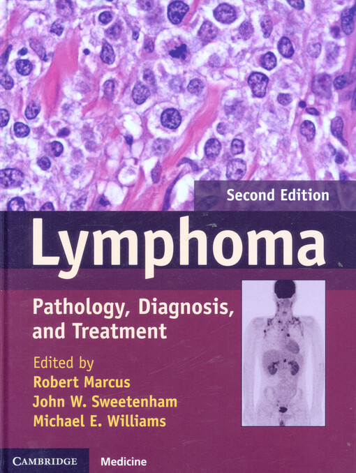 Lymphoma :pathology, diagnosis, and treatment