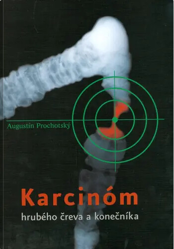 Karcinóm hrubého čreva a konečníka