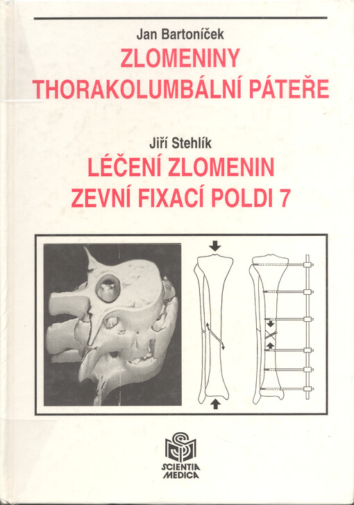 Zlomeniny thorakolumbální páteře