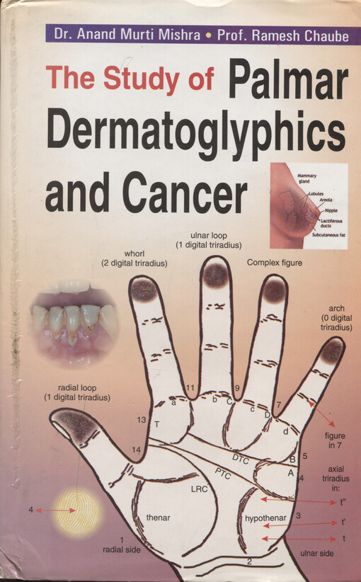 The study of palmar dermatoglyphics and cancer
