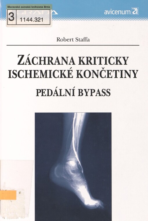 Záchrana kriticky ischemické končetiny: pedální bypass