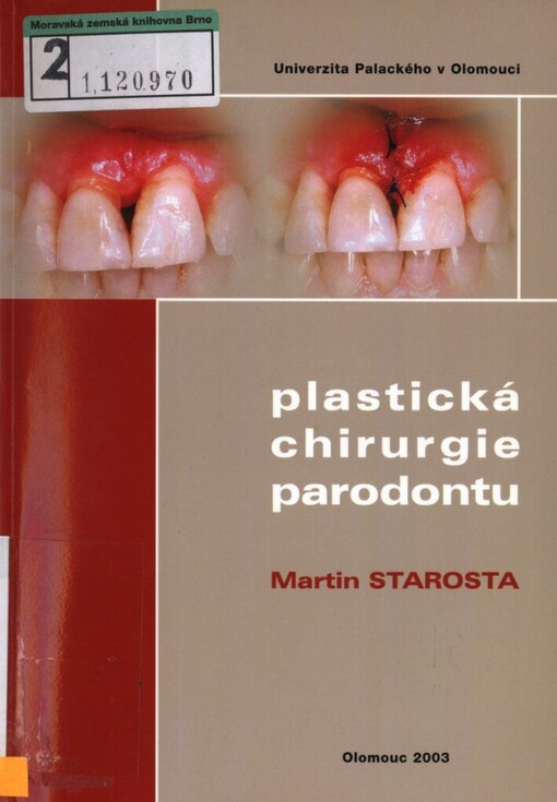 Plastická chirurgie parodontu