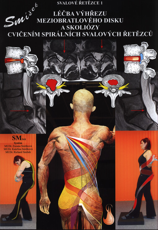 Spirální stabilizace páteře : léčba výhřezu meziobratlového disku a skoliózy : metoda Spirální stabilizace páteře : SMíšek Systém