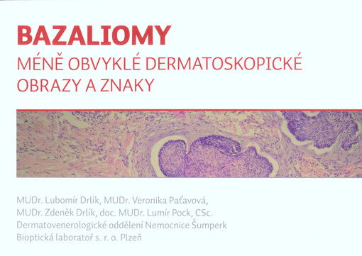 Bazaliomy : méně obvyklé dermatoskopické obrazy a znaky