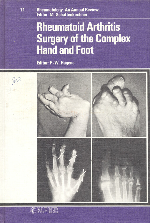 Rheumatoid arthritis surgery of the complex hand and foot