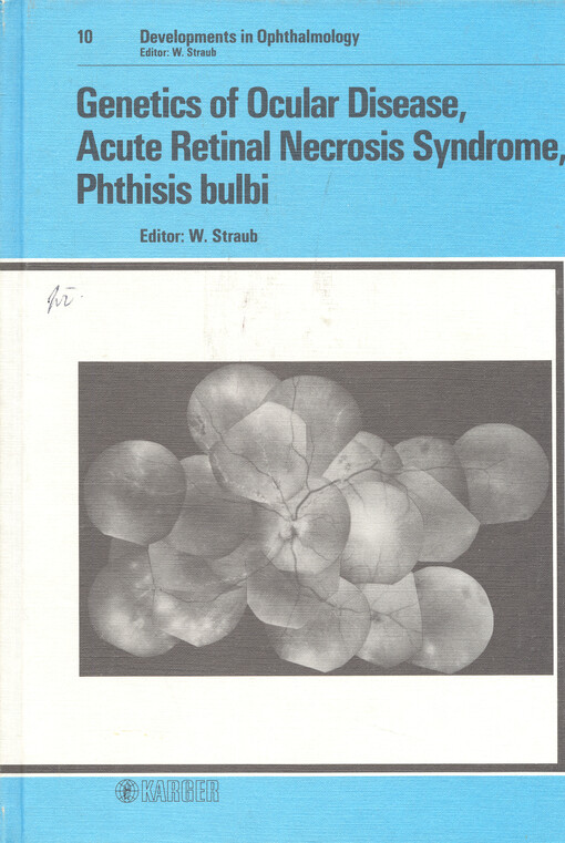 Genetics of ocular disease : Acute retinal necrosis syndrome : Phthisis bulbi