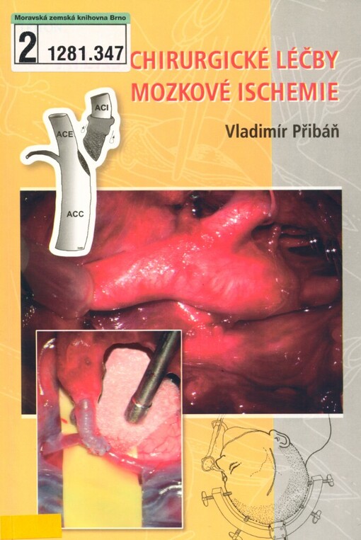 Atlas chirurgické léčby mozkové ischemie
