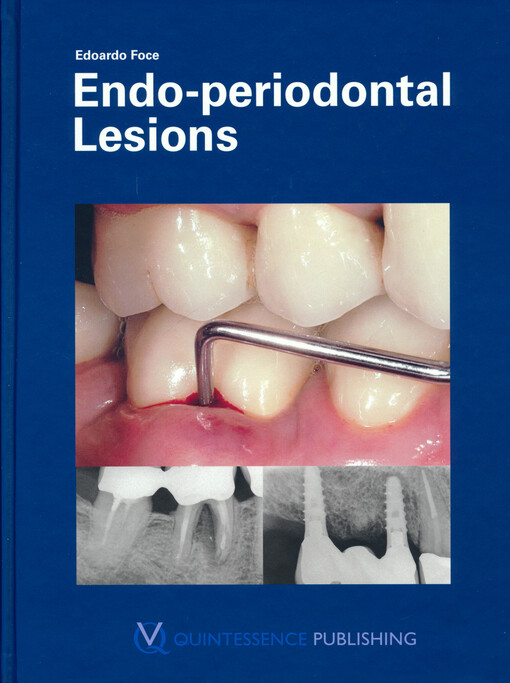 Endo-periodontal lesions