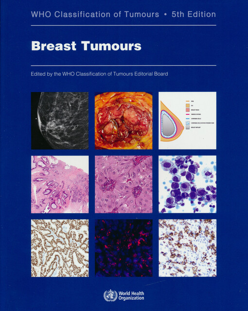 Breast tumours