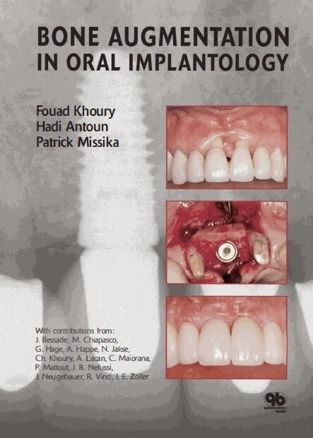 Bone Augmentation in Oral Implantology