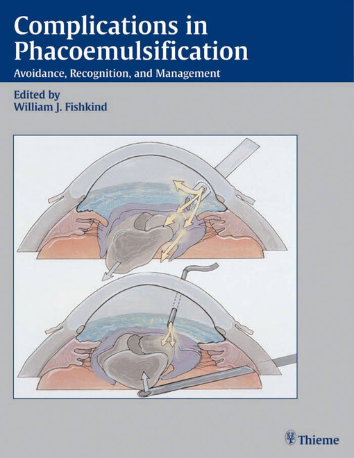 Complications in phacoemulsification : avoidance, recognition, and management
