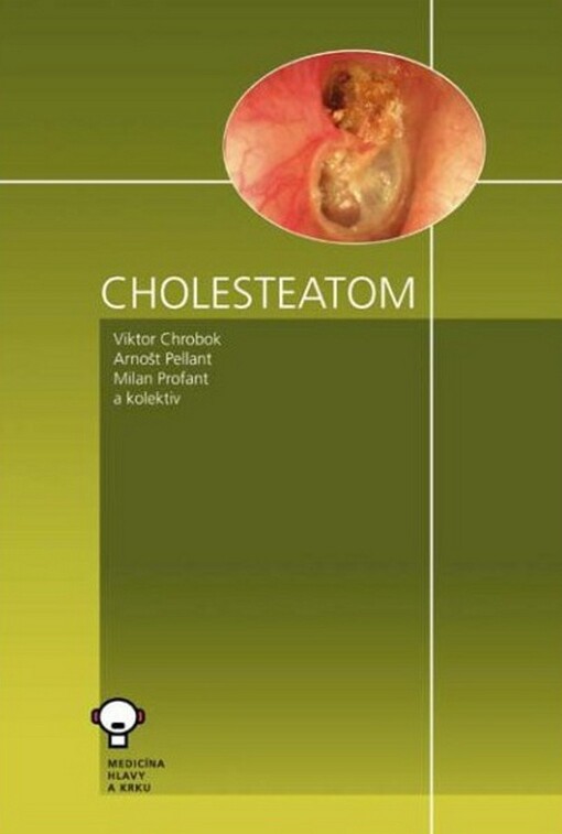 Cholesteatom spánkové kosti