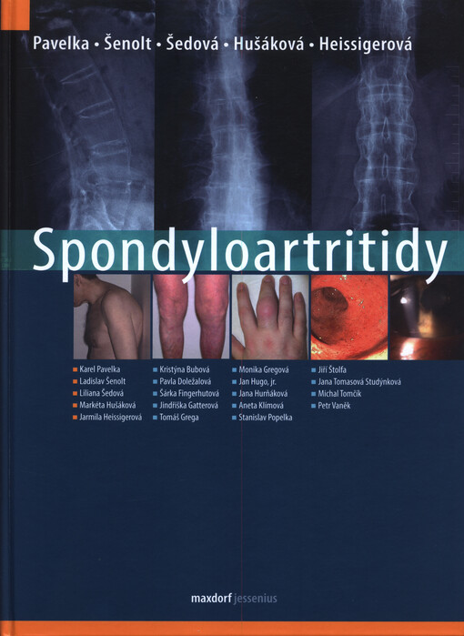 Spondyloartritidy