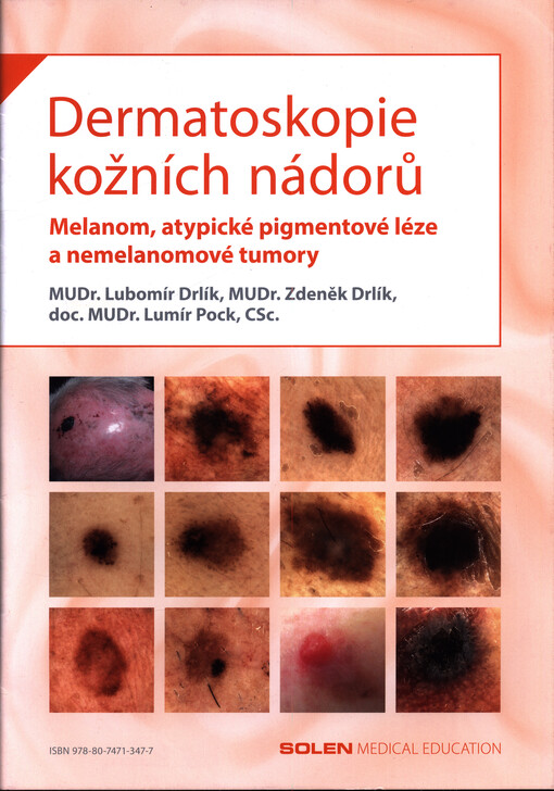 Dermatoskopie kožních nádorů