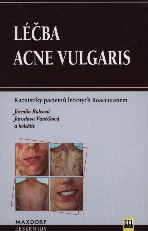 Léčba acne vulgaris :kazuistiky pacientů léčených Roaccutanem