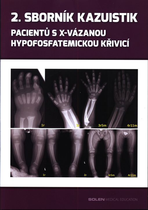 2. sborník kazuistik pacientů s X-vázanou hypofosfatemickou křivicí