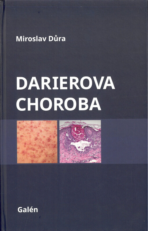 Darierova choroba