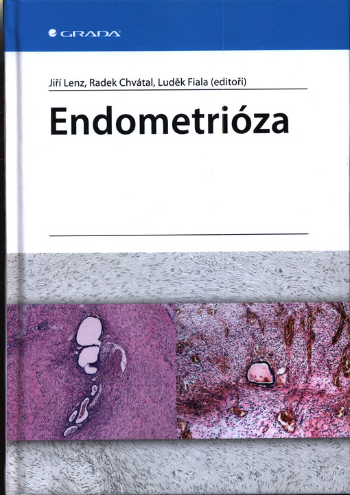 Endometrióza