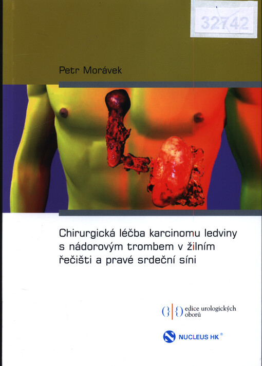 Chirurgická léčba karcinomu ledviny s nádorovým trombem v žilním řečišti a pravé srdeční síni