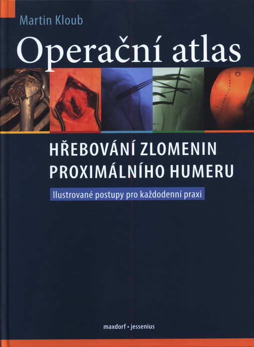 Operační atlas hřebování zlomenin proximálního humeru