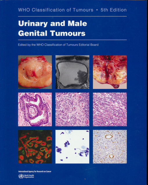 Urinary and male genital tumours