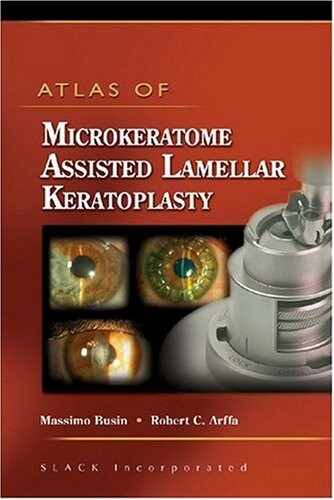Atlas of Microkeratome Assisted Lamellar Keratoplasty