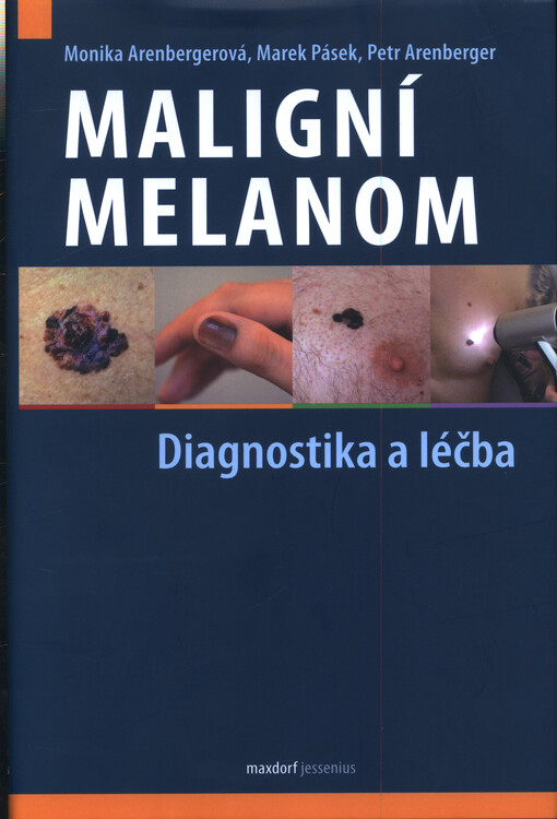 Maligní melanom - diagnostika a léčba : na základě aktuálního doporučeného postupu