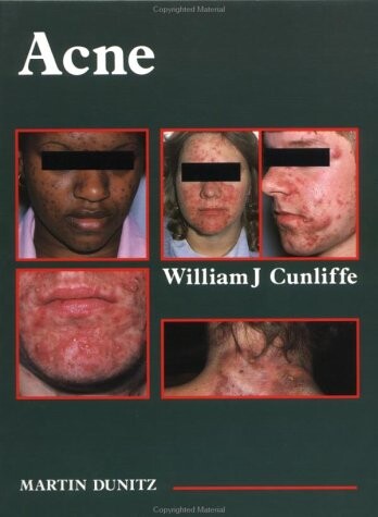 Acne