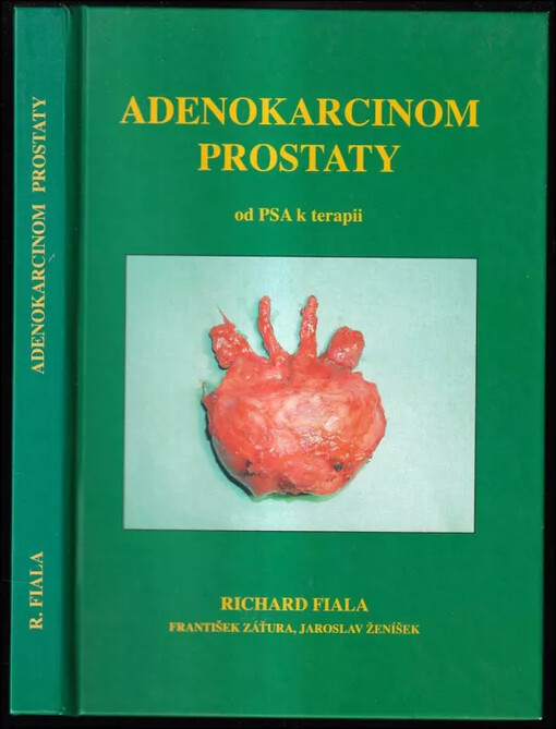 Adenokarcinom prostaty
