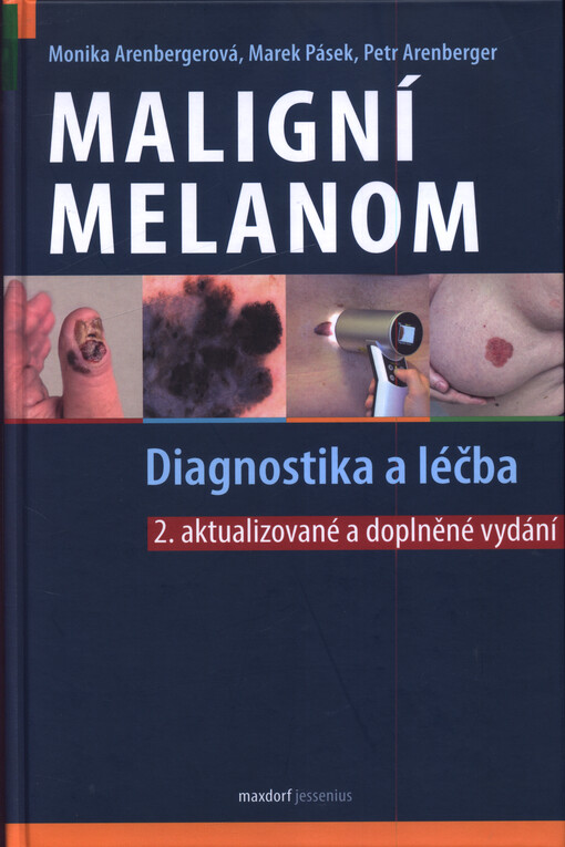 Maligní melanom : diagnostika a léčba : na základě aktuálního doporučeného postupu
