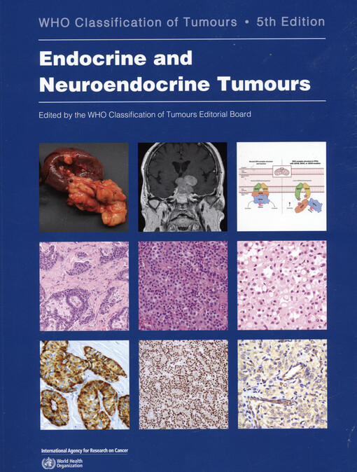 Endocrine and neuroendocrine tumours