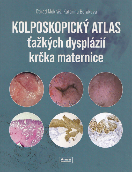 Kolposkopický atlas ťažkých dysplázií krčka maternice