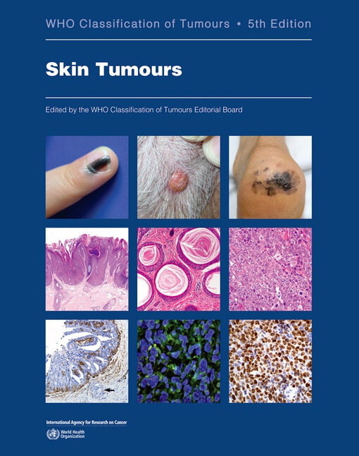 Skin tumours