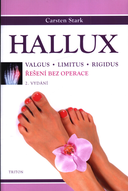 Hallux : valgus, limitus, rigidus