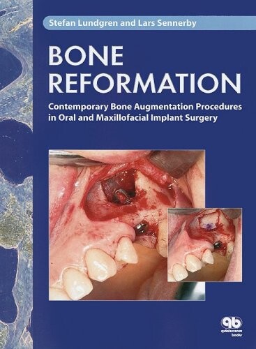 Bone reformation : contemporary bone augmentation procedures in oral and maxillofacial implant surgery