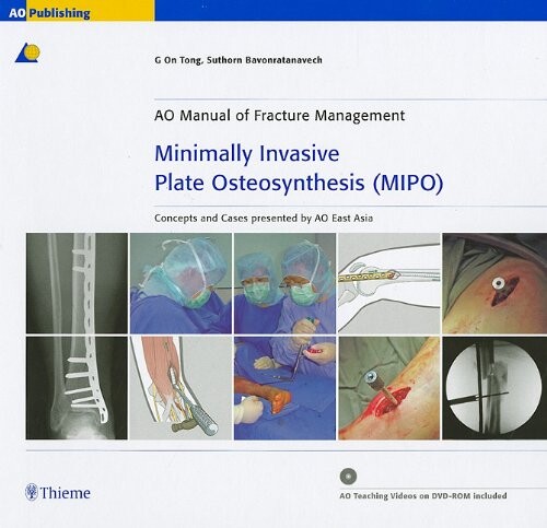 Minimally Invasive Plate Osteosynthesis (MIPO): Concepts and cases presented by the AO East Asia (Ao Manual of Fracture Management)