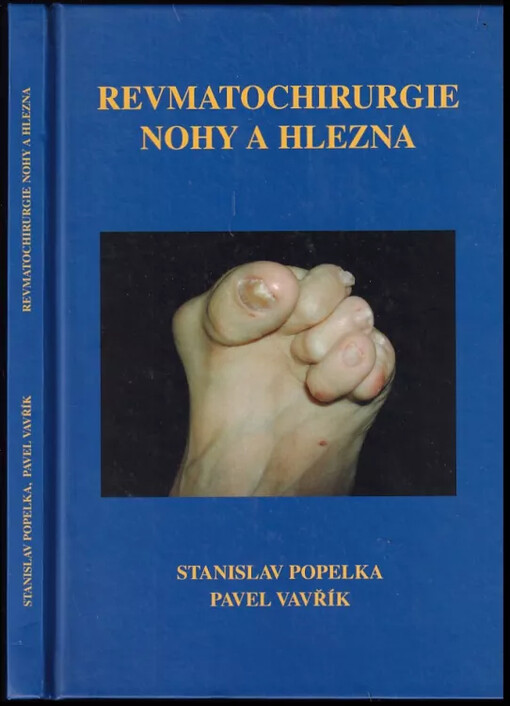 Revmatochirurgie nohy a hlezna