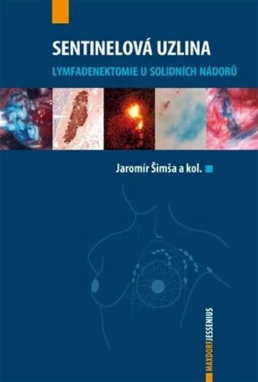 Sentinelová uzlina: lymfadenektomie u solidních nádorů