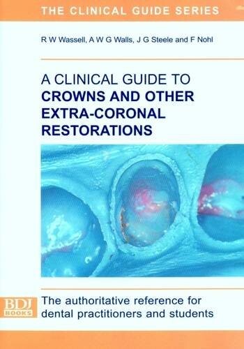 A Clinical Guide to Crowns and Other Extra-coronal Restorations