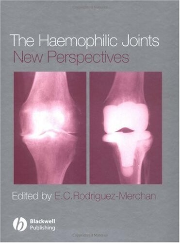 The Haemophilic Joints: New Perspectives
