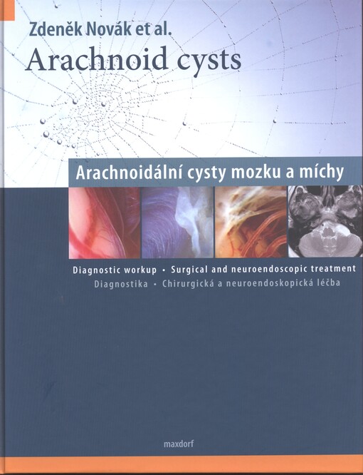Arachnoid cysts